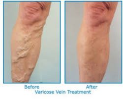 Varicose Vein Treatment Center California