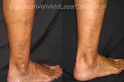 Spider Vein Treatment Center in Long Island