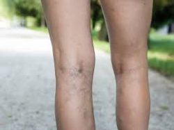 What causes Varicose Veins?