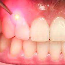 Effect Laser Treatment for Your Gum Problems