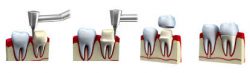 Dental Implants in Houston, TX