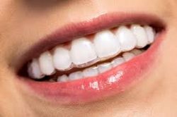 INVISALIGN COST, HOW MUCH IS INVISALIGN?