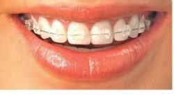 Invisalign Clear Braces in Houston