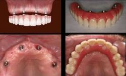 All On 4 Dental Implants Near Me