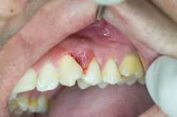 What is Periodontitis?