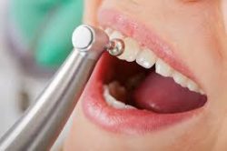 Best Affordable Dental Cleaning in Houston