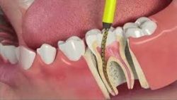 Root Canal Treatments