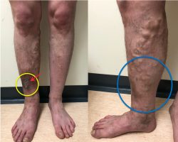 How Can I Find the Best Varicose Vein Treatment Center Near Me?