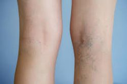 How to Treat Varicose Veins in San Diego?