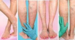 Varicose Vein Treatments Center NYC