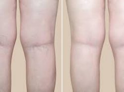 Laser Vein Treatment Near Me