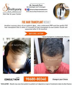 FUE HAIR TRANSPLANT IN DELHI- BEST DERMATOLOGIST IN DELHI- DR. SURUCHI PURI