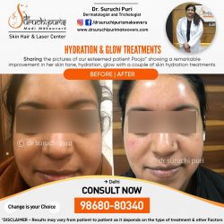 HYDRATION & GLOW TREATMENT IN DELHI- BEST DERMATOLOGIST IN DELHI- DR. SURUCHI PURI