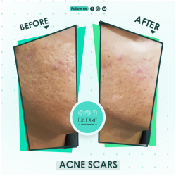 Acne Scar Treatment in Bangalore