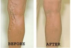 Venous Insufficiency Treatment in Houston