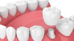 Affordable Dentures in Houston, TX