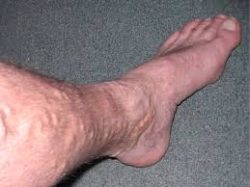 Who is at Risk for Spider Veins?