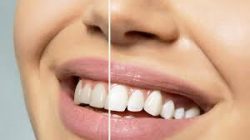 Emergency Laser Teeth Whitening Houston