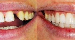 Cosmetic Dental Bridge Treatment