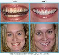 One of The Best Veneer Dentist In Houston