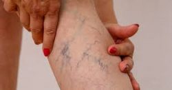 What are the symptoms of Spider Veins?