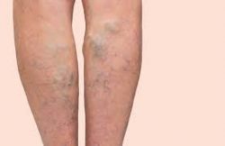 Top Qualities you Should Look for in a Vein Doctor