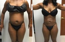 Smart Lipo Surgery in Houston