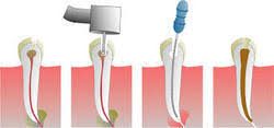 Root Canal Treatment Near Me