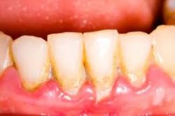 Periodontal Disease Treatment Near Me