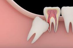 Affordable Wisdom Teeth Removal Houston, TX