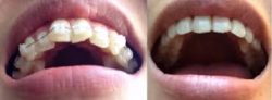 Adult Braces Near Me