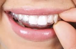 Invisalign Braces Near Me