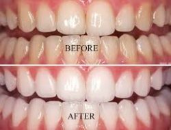 Best Teeth Whitening Services Perth & Subiaco — Tx Smiles