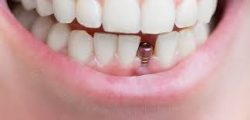 Single Dental Implant Cost