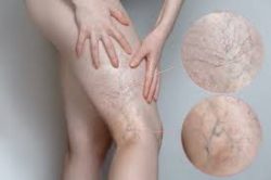 Varicose Veins