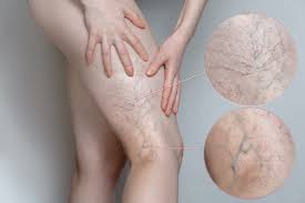 Varicose Veins