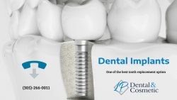 Rejuvenate Your Smile with Dental Implants