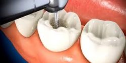 Root Canal in Houston, TX