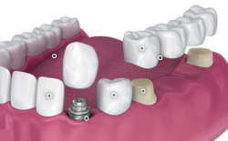 Dental Crown and Bridge Services Highwood