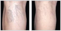 Best Laser Treatment For Spider Veins On Legs