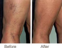 Before And After Sclerotherapy