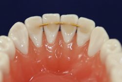 HOW MUCH DOES DENTAL BONDING COST?