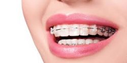 Find The Best Braces Cost Near Me