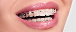 Choosing A Dental Clinic For Braces