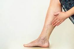 Chronic Venous Insufficiency Test