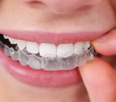 ARE CLEAR RETAINERS THE BEST TYPE OF RETAINERS?