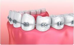 Best Dental Braces Near Me