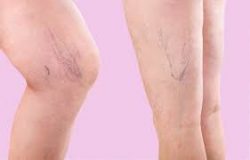 Best Varicose Vein Treatment Clinic?