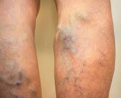 Spider Veins Treatments Near Me