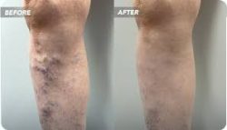 Varicose Veins Treatment Near Me